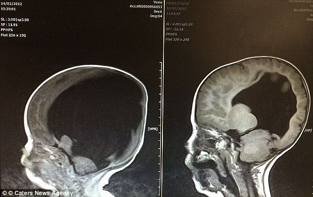 Hydrocephalus is a condition1